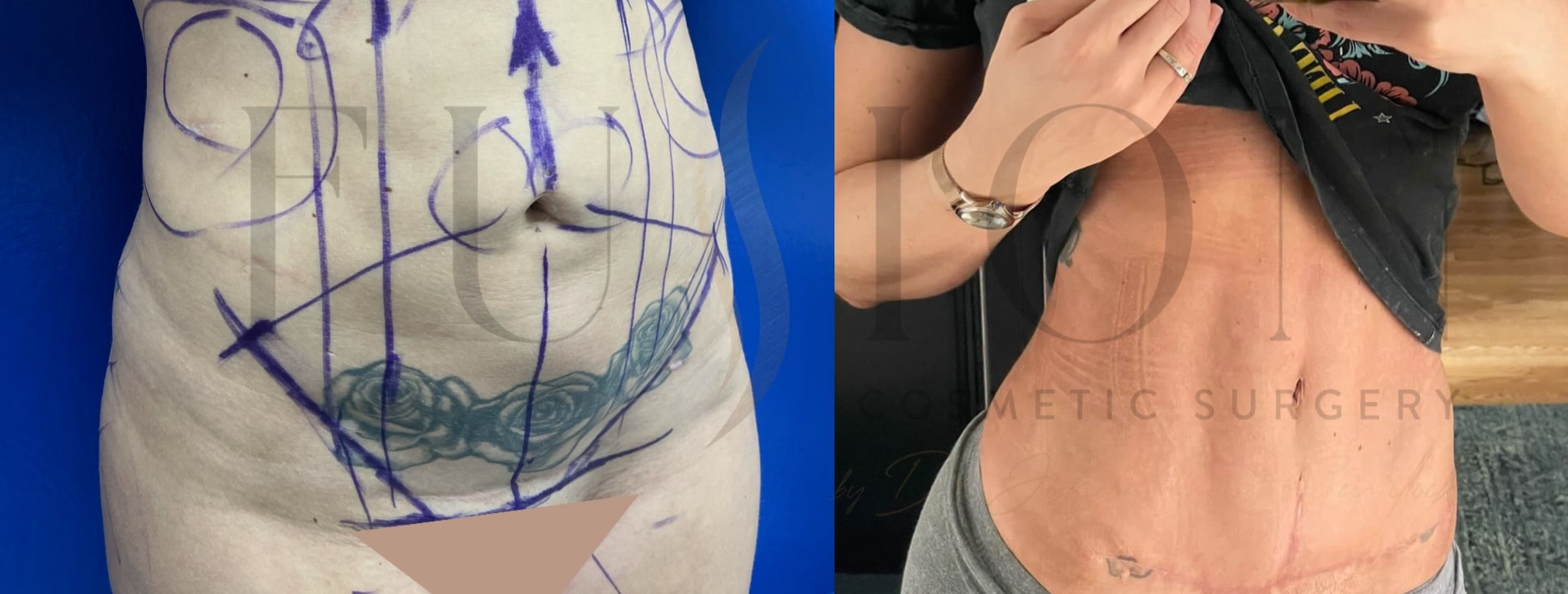 Curvy Tuck Before & After Image