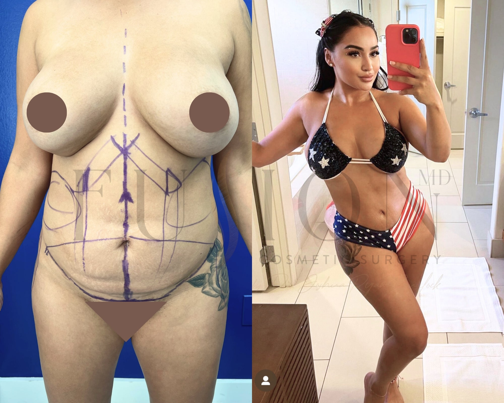 Curvy Tuck Before & After Image
