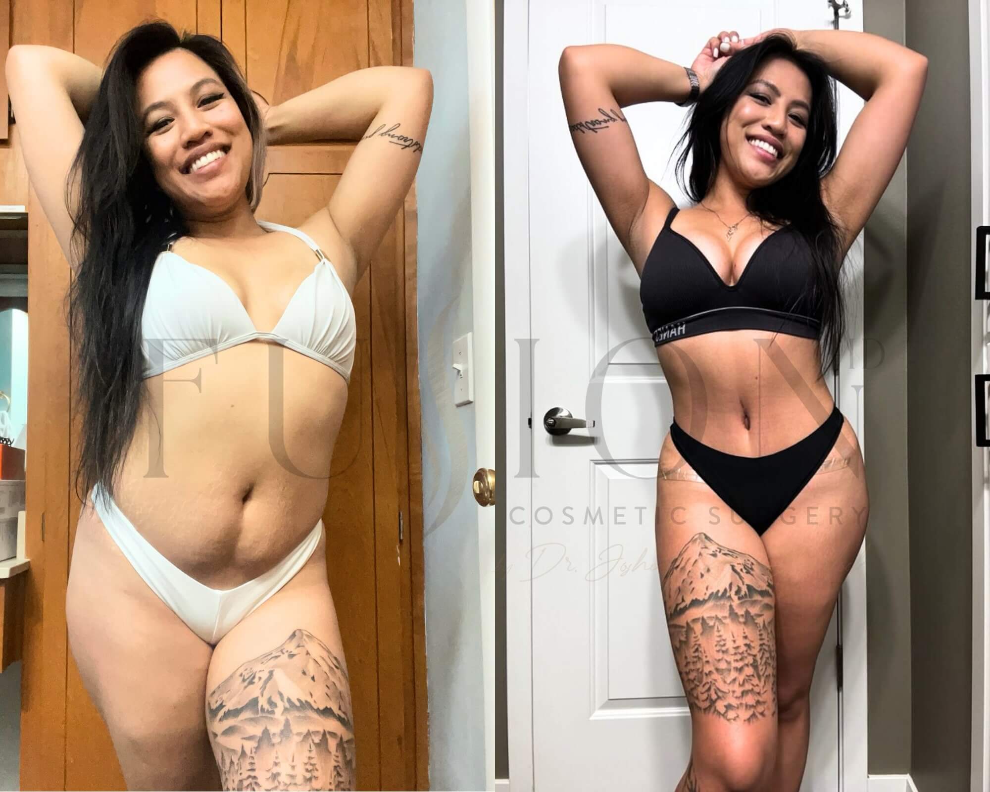 Curvy Tuck Before & After Image