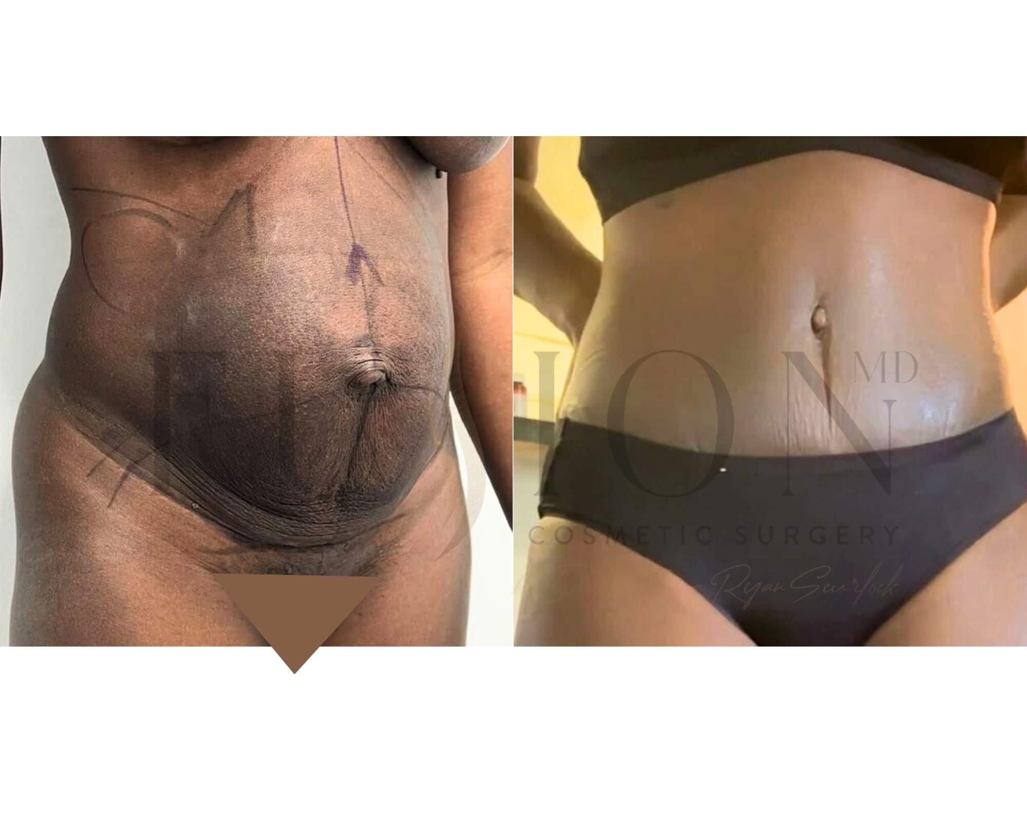 Curvy Tuck Before & After Image