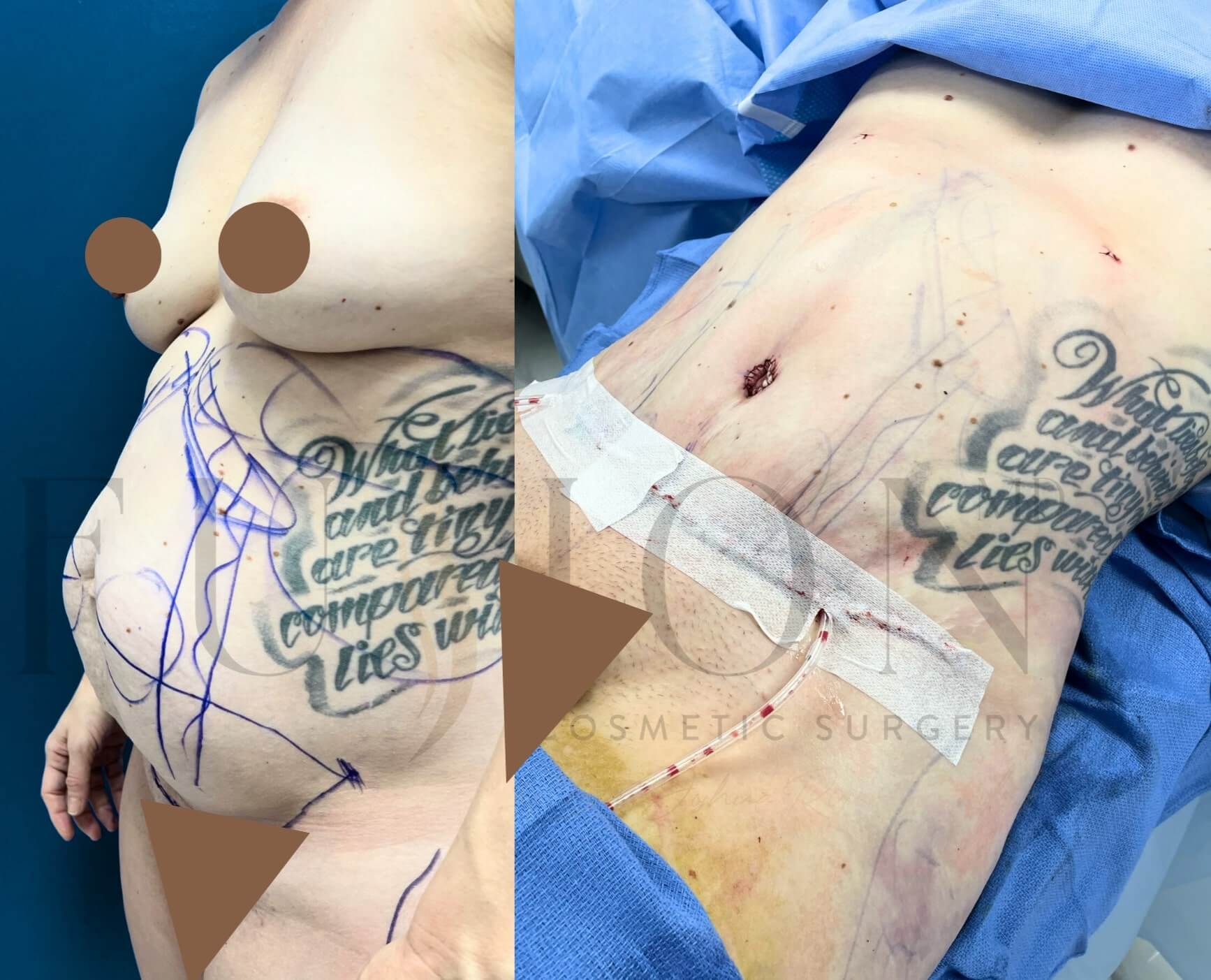 Curvy Tuck Before & After Image