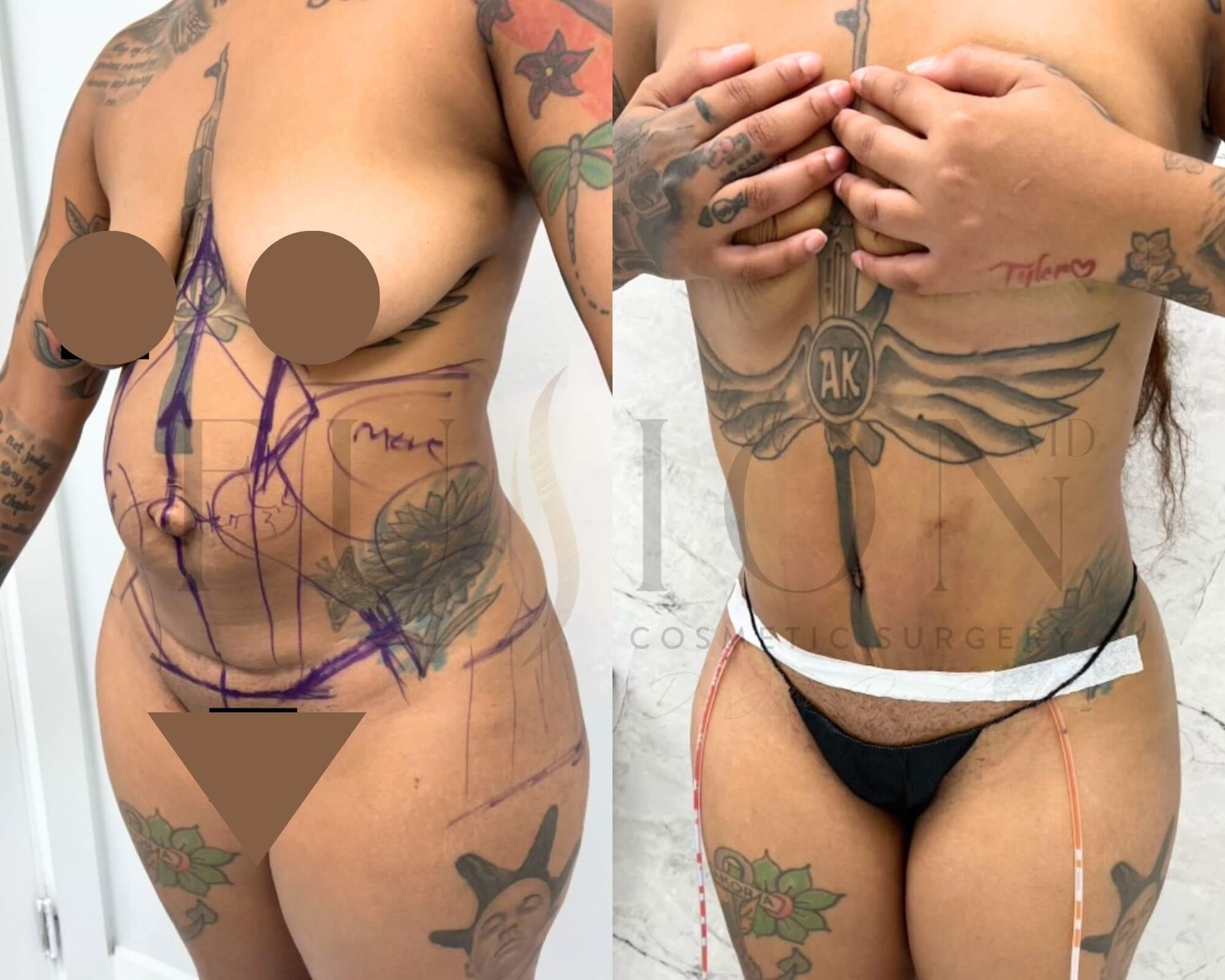 Curvy Tuck Before & After Image