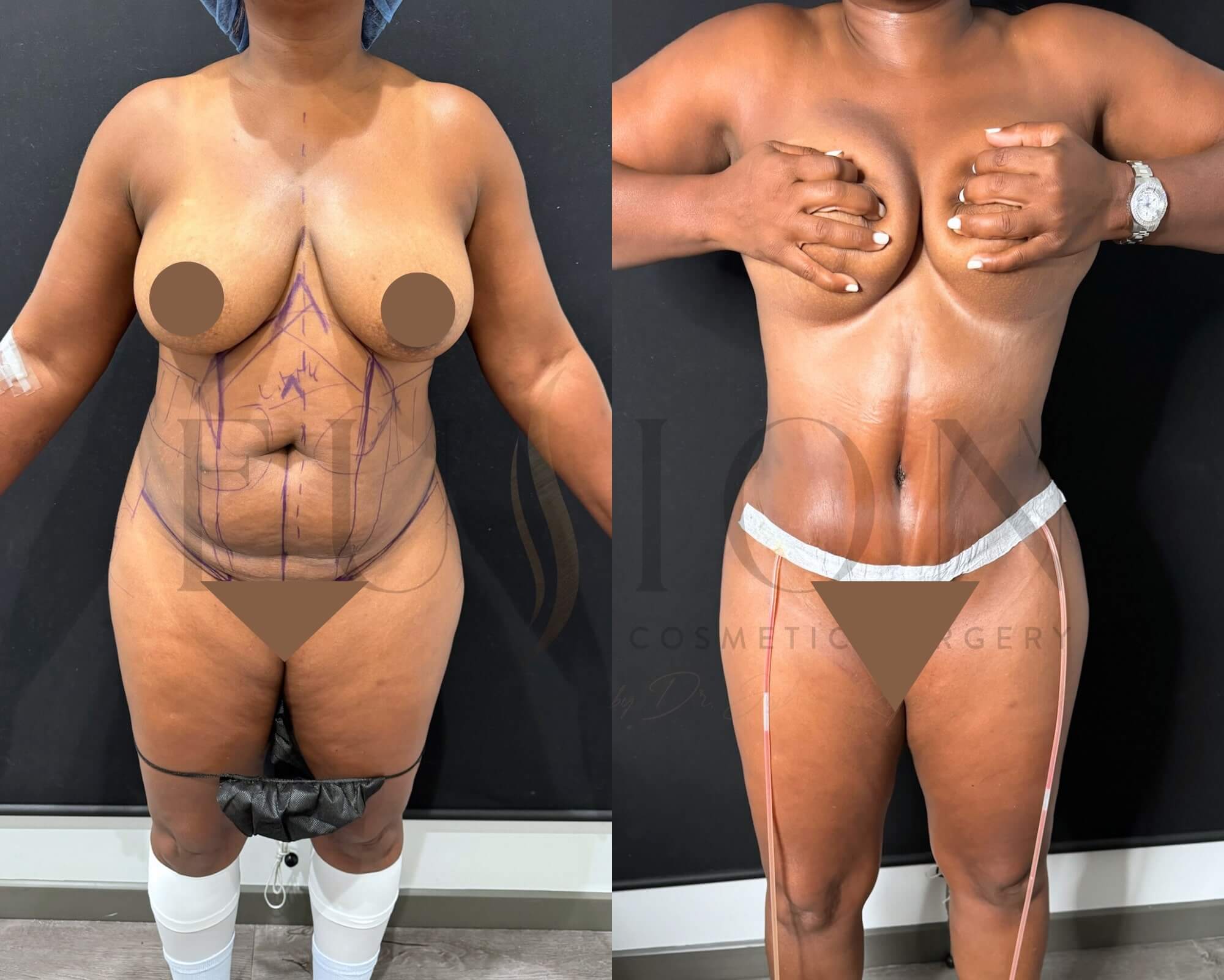 Curvy Tuck Before & After Image