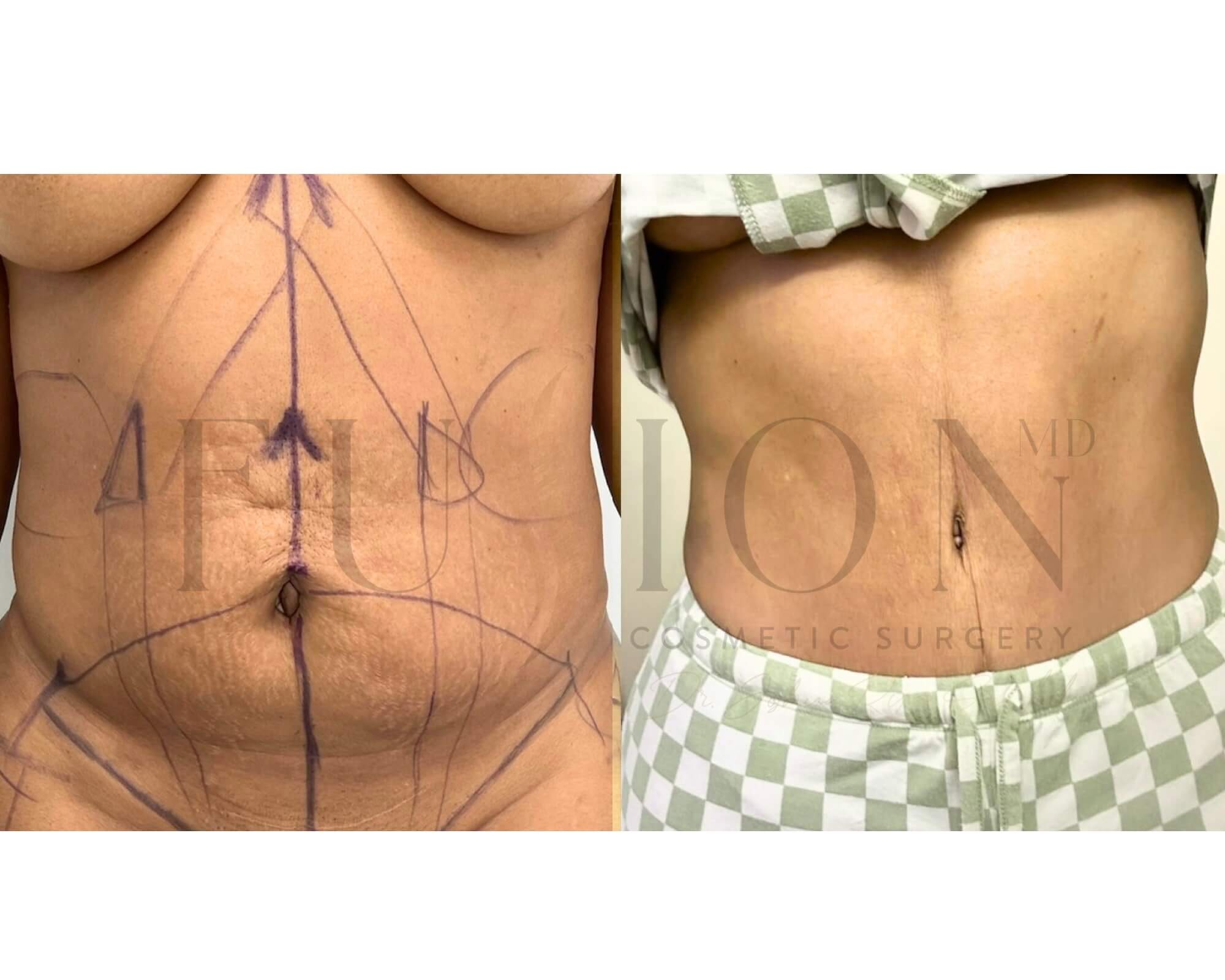 Curvy Tuck Before & After Image