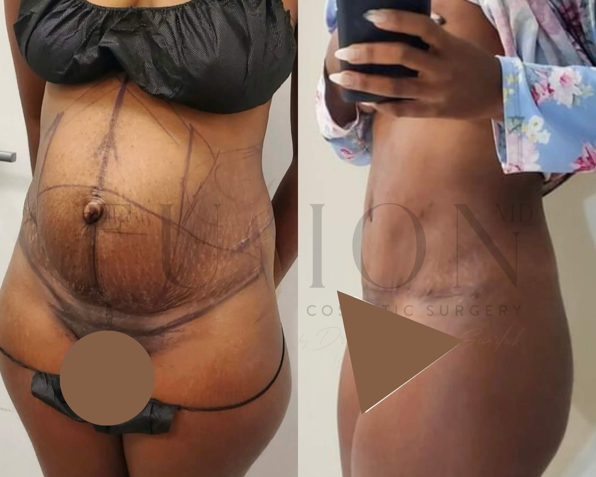 Curvy Tuck Before & After Image