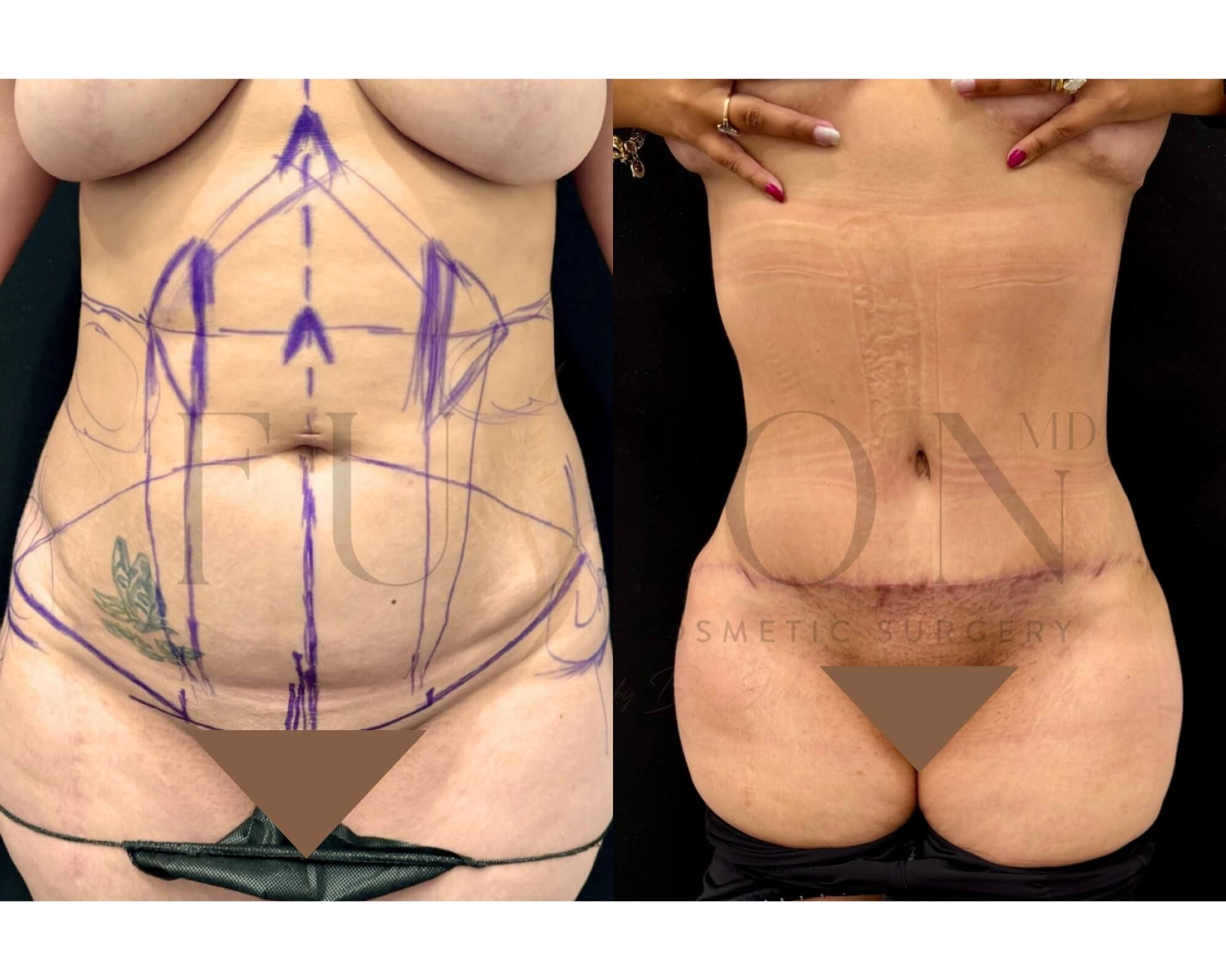 Curvy Tuck Before & After Image