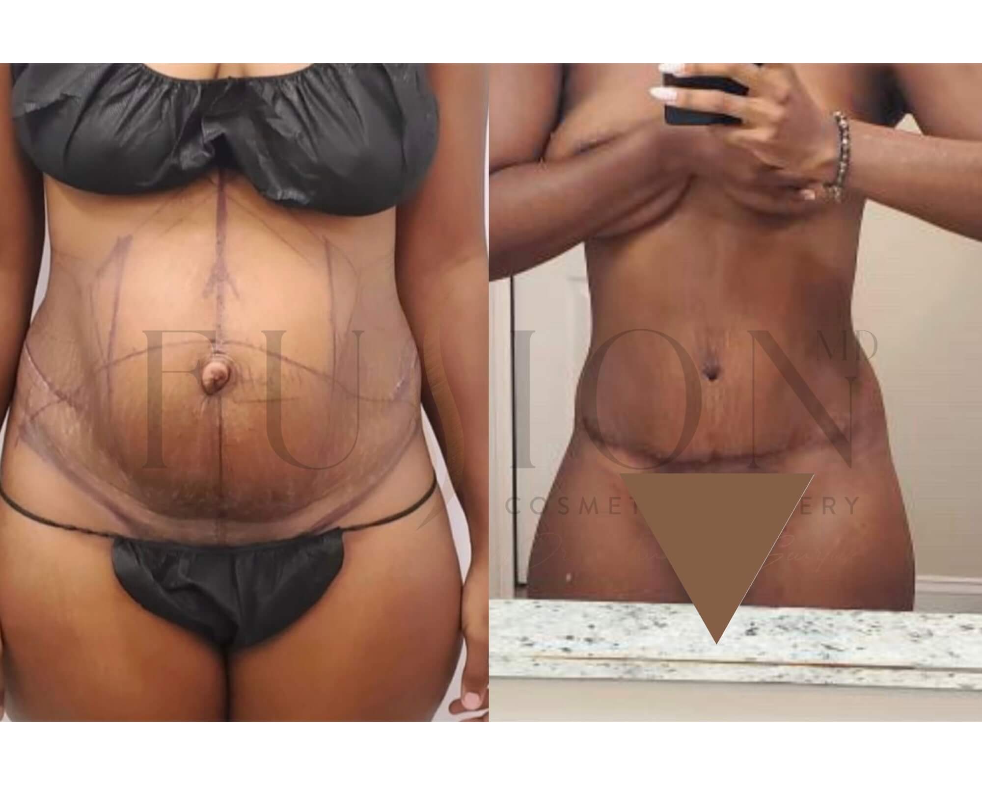 Curvy Tuck Before & After Image
