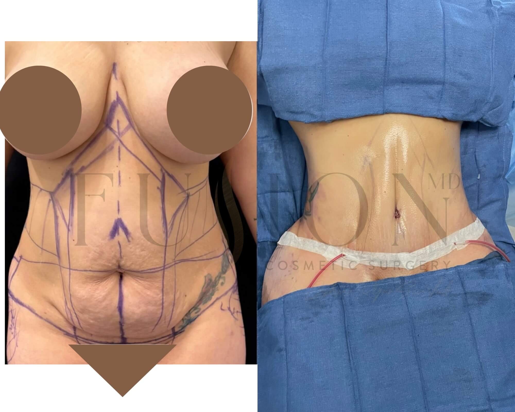Curvy Tuck Before & After Image