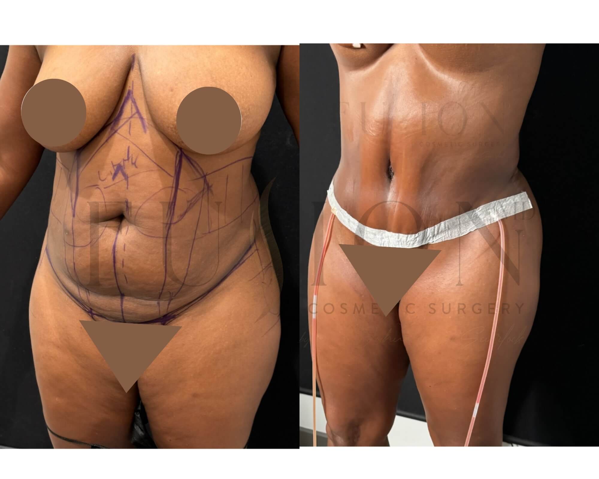 Curvy Tuck Before & After Image
