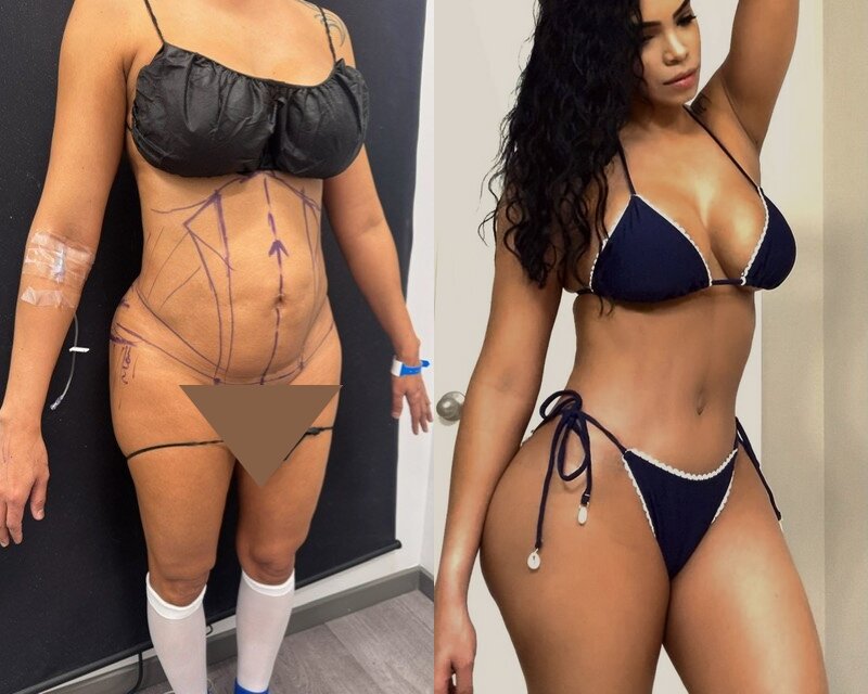 curvy tuck Before & After Image