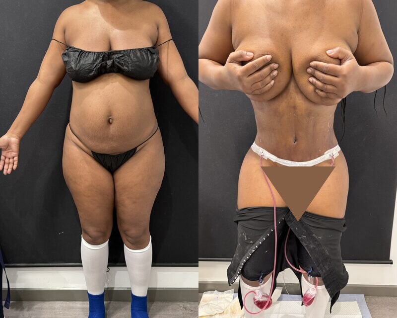 curvy tuck Before & After Image