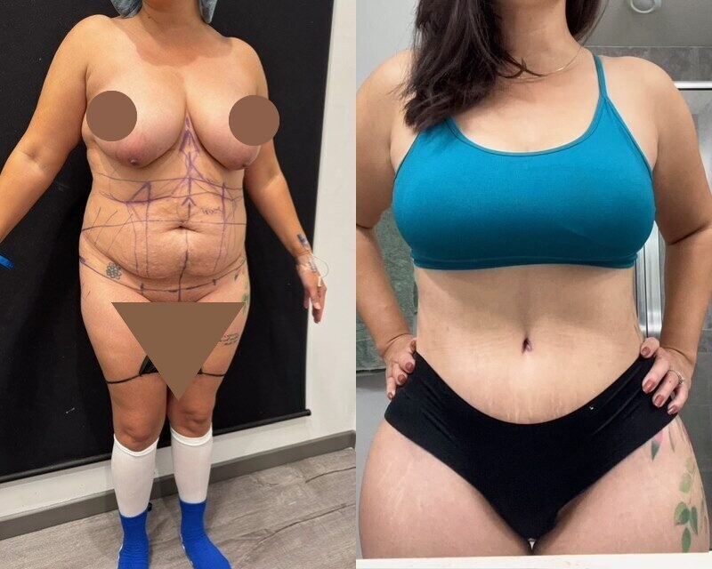 curvy tuck Before & After Image