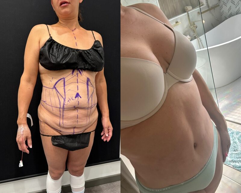 curvy tuck Before & After Image