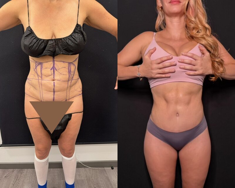 curvy tuck Before & After Image