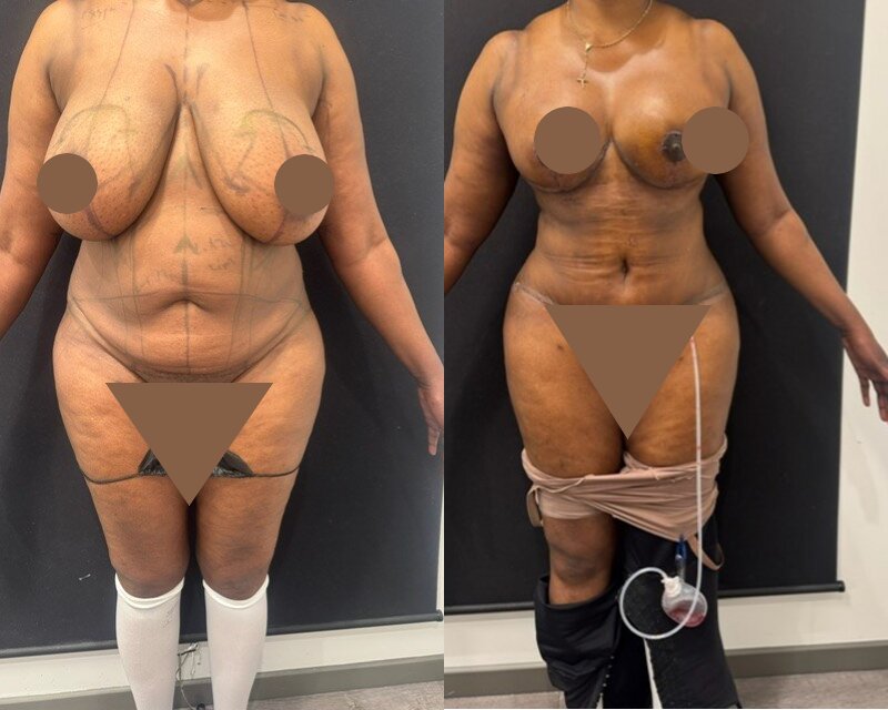 curvy tuck Before & After Image