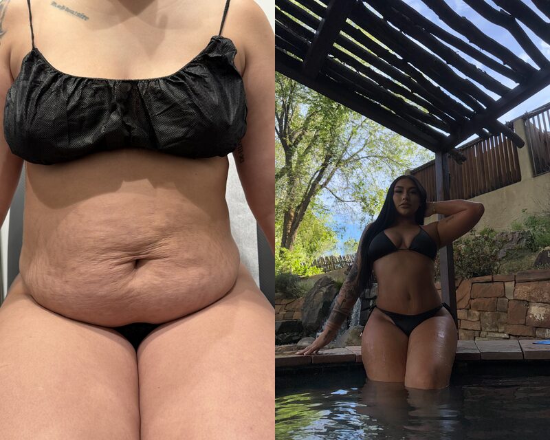 curvy tuck Before & After Image