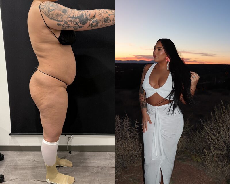 curvy tuck Before & After Image