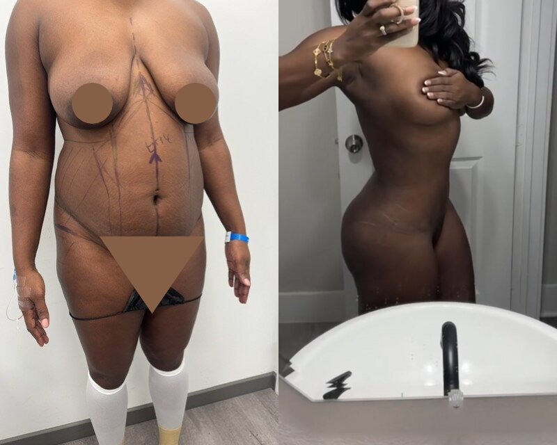 curvy tuck Before & After Image