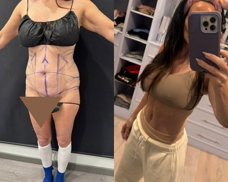 curvy tuck Before & After Image