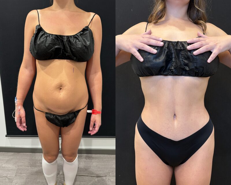 curvy tuck Before & After Image