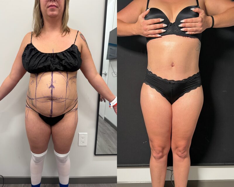 Curvy Tuck Before & After Image