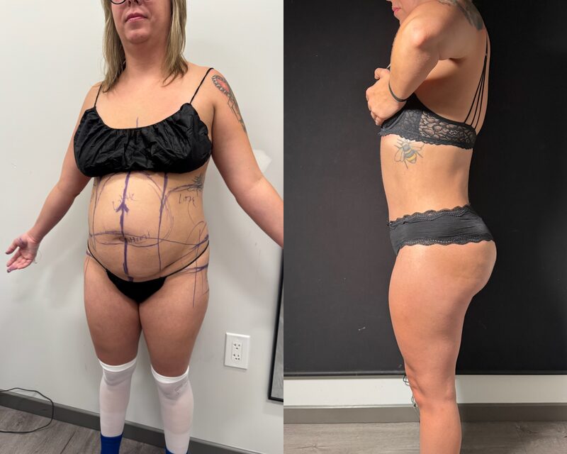 curvy tuck Before & After Image