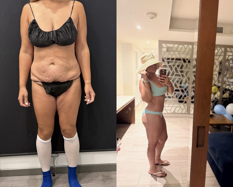 Curvy Tuck Before & After Image