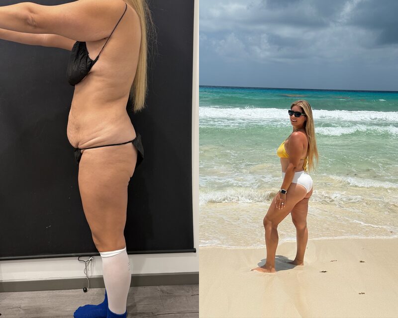 Curvy Tuck Before & After Image