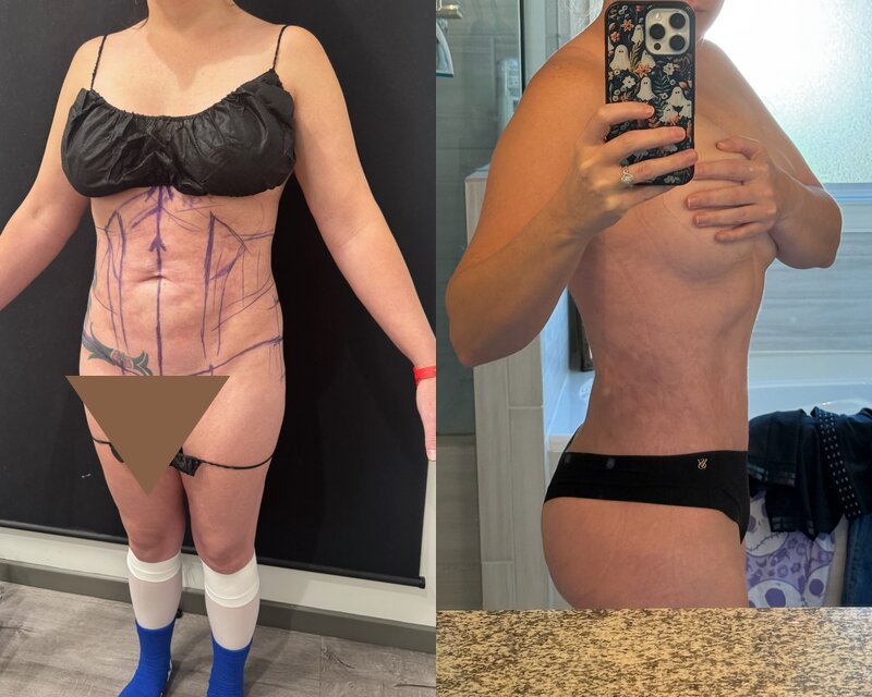 Curvy Tuck Before & After Image