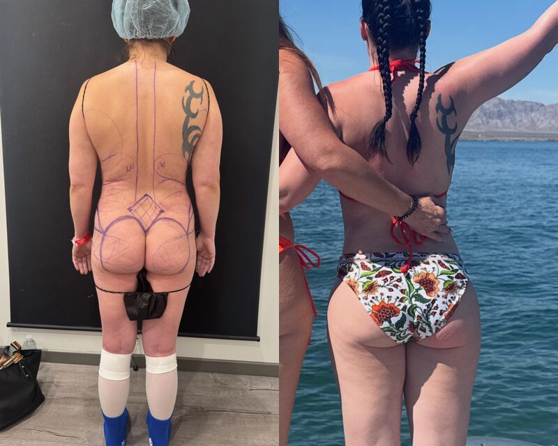 Curvy Tuck Before & After Image