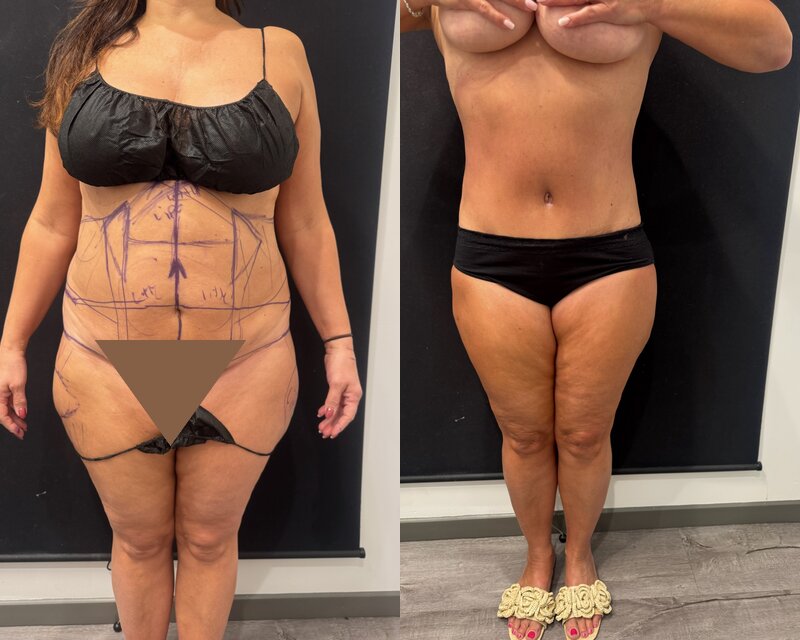 Curvy Tuck Before & After Image