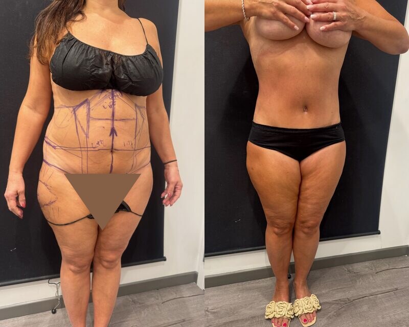 Curvy Tuck Before & After Image