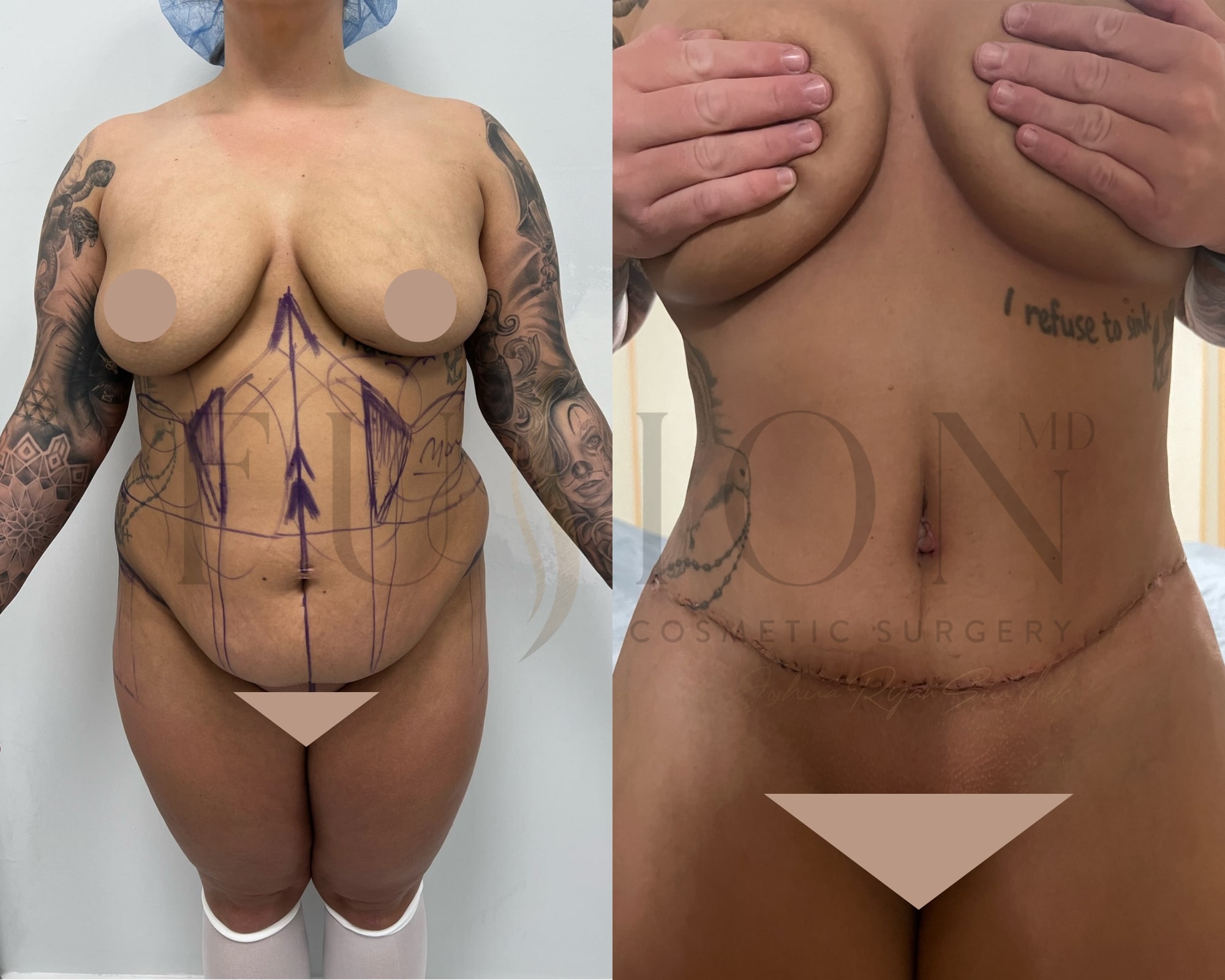 Extended Curvy Tuck Before & After Image