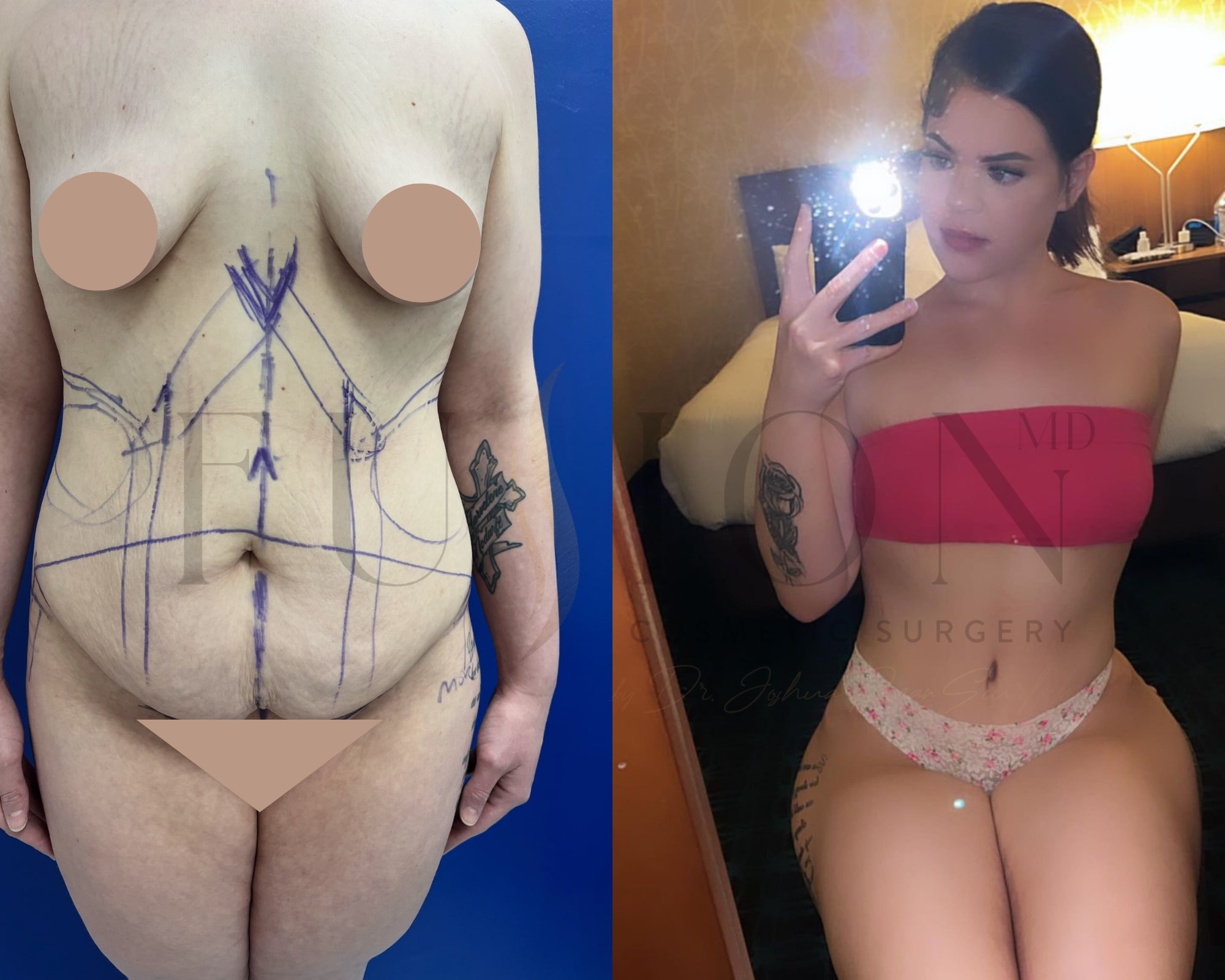 Extended Curvy Tuck Before & After Image
