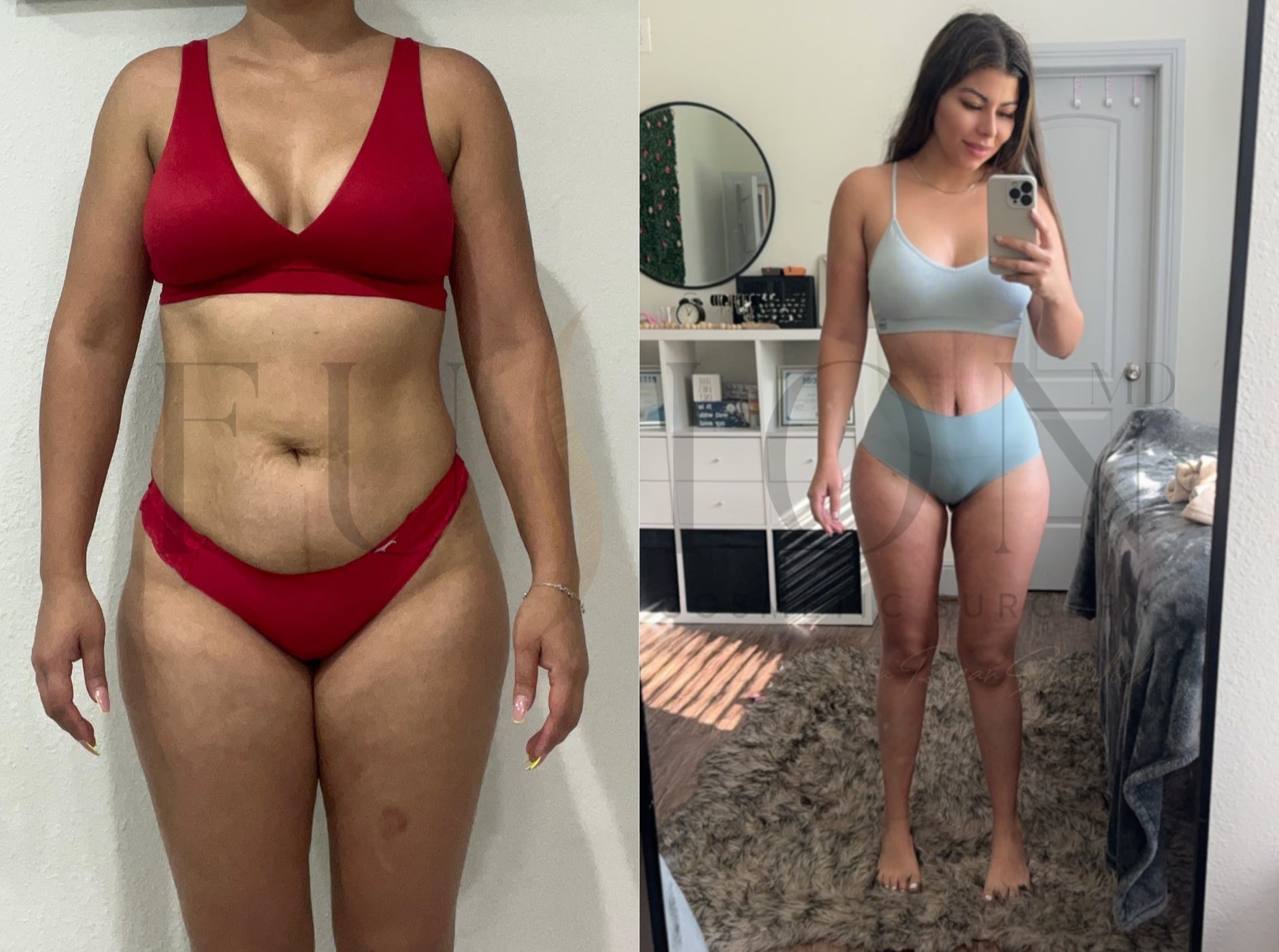 Extended Curvy Tuck Before & After Image