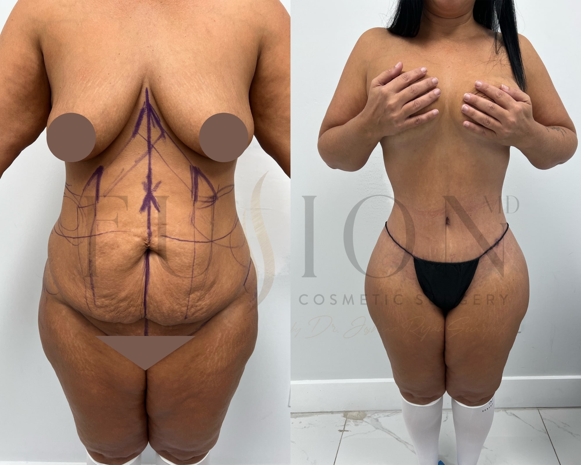 Extended Curvy Tuck Before & After Image