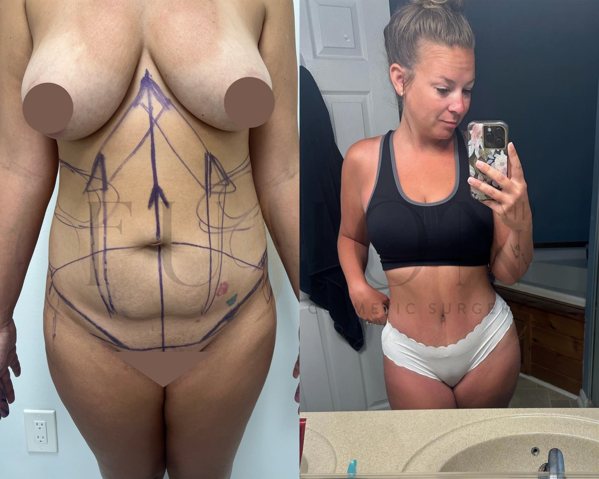 Extended Curvy Tuck Before & After Image