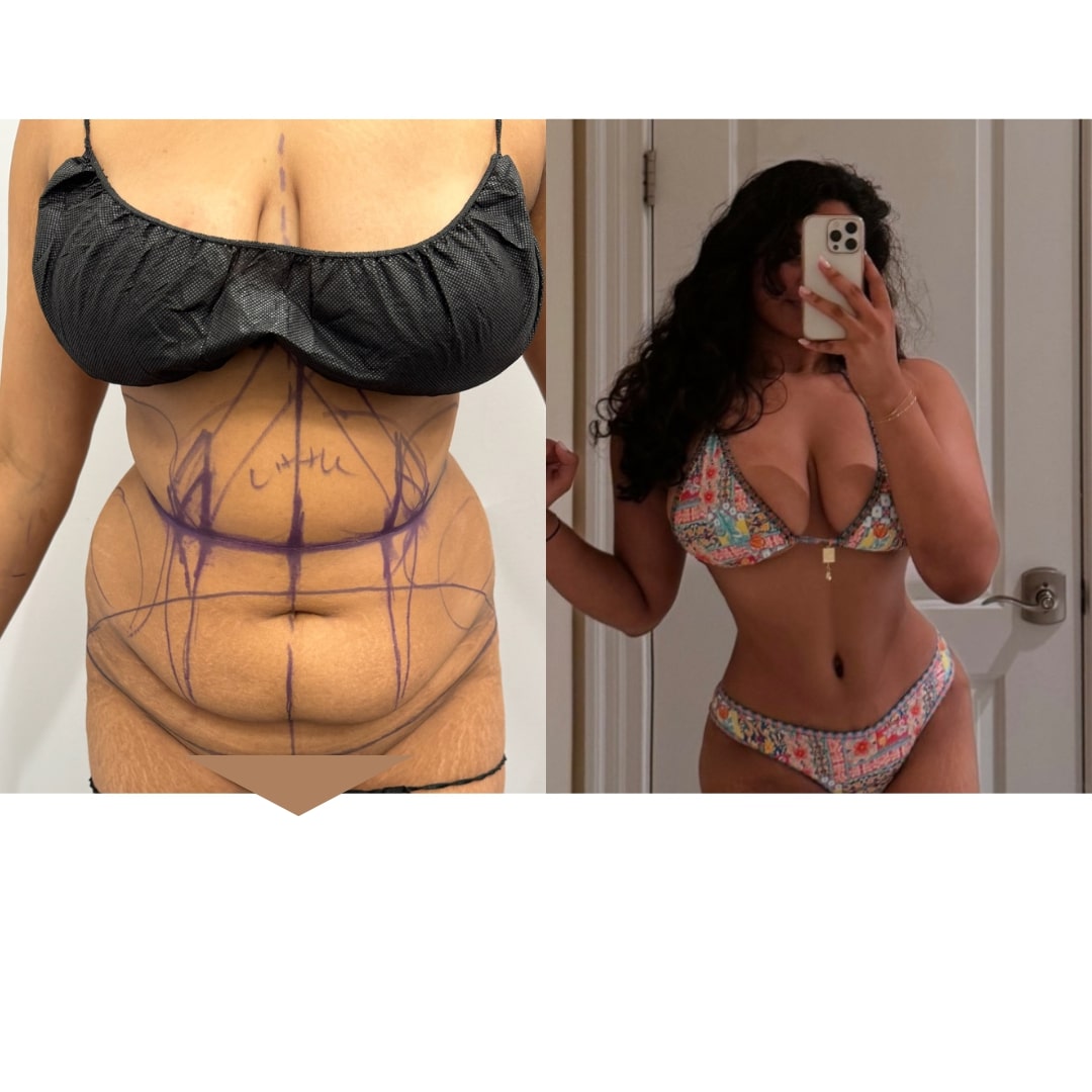 Extended Curvy Tuck Before & After Image