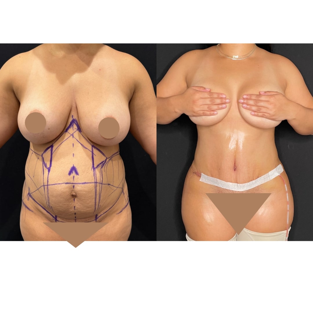 Extended Curvy Tuck Before & After Image