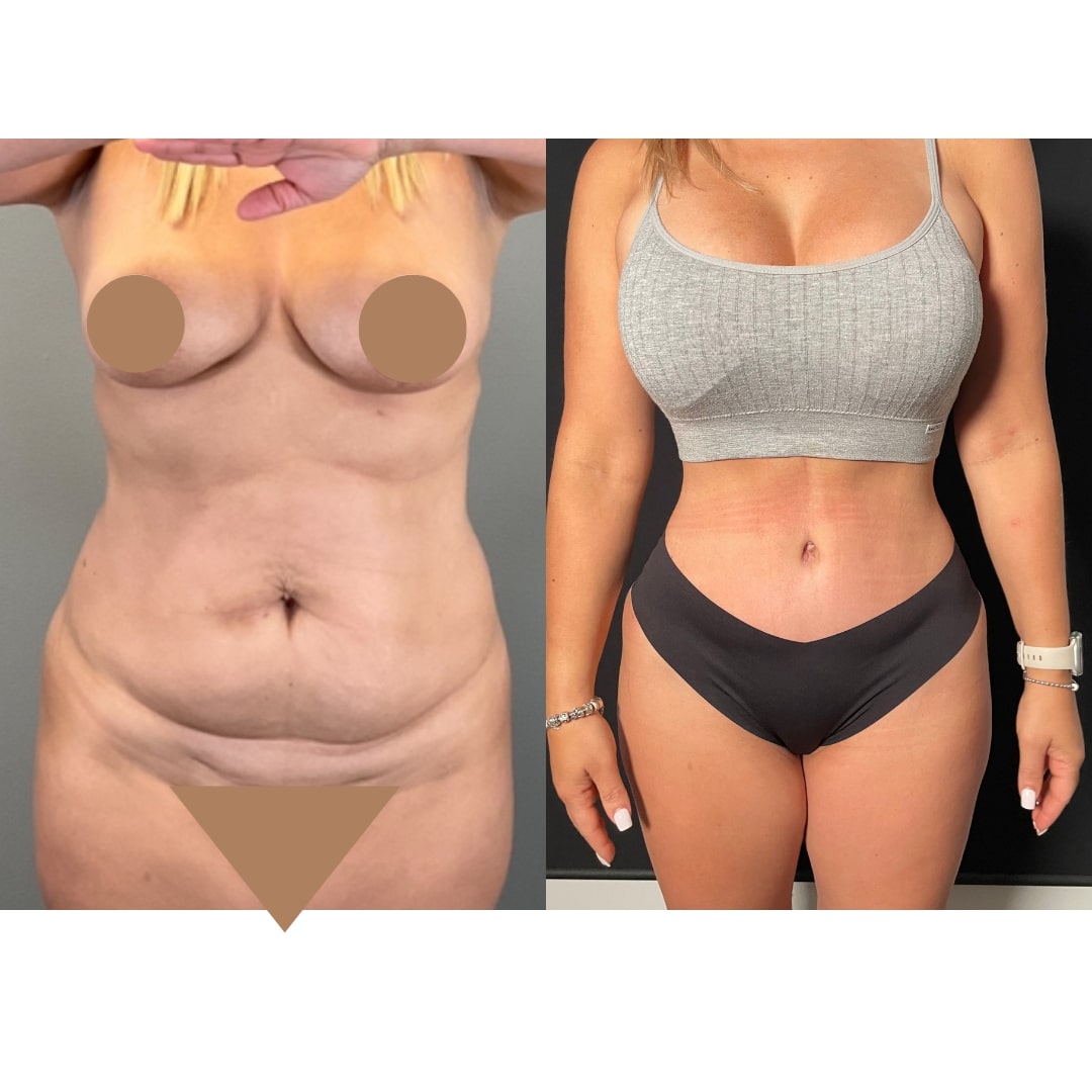 Extended Curvy Tuck Before & After Image