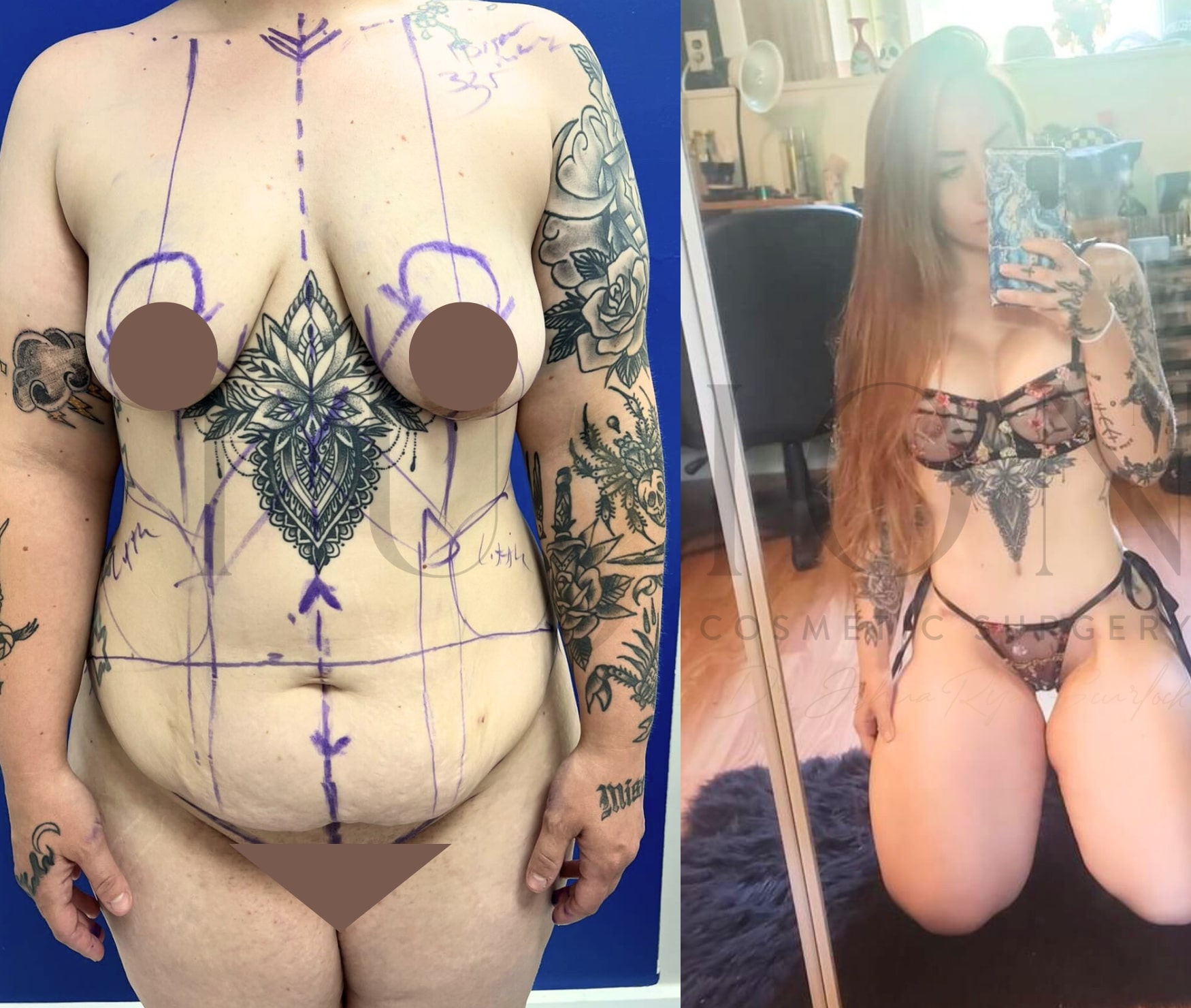 Extended Curvy Tuck Before & After Image