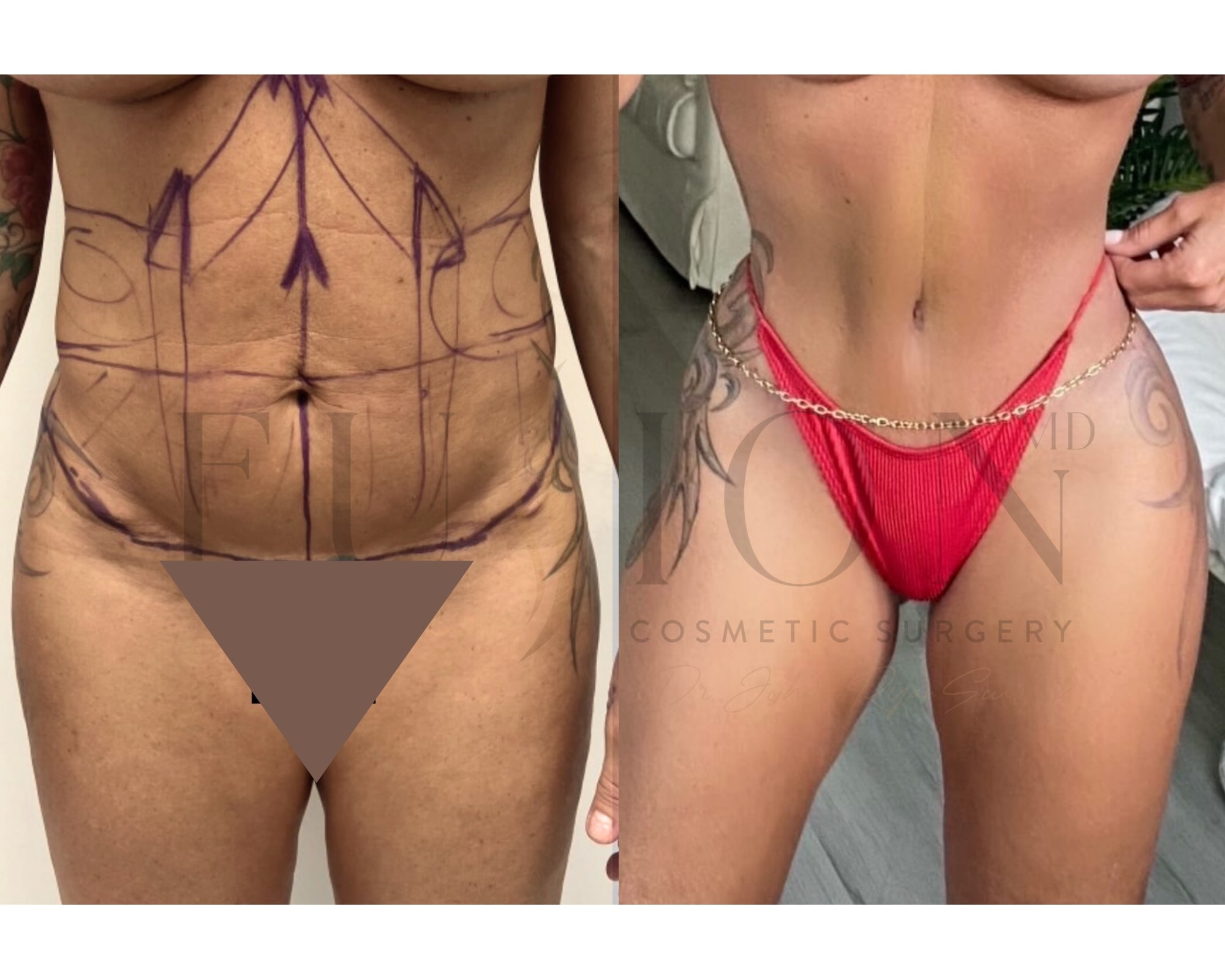 Extended Curvy Tuck Before & After Image