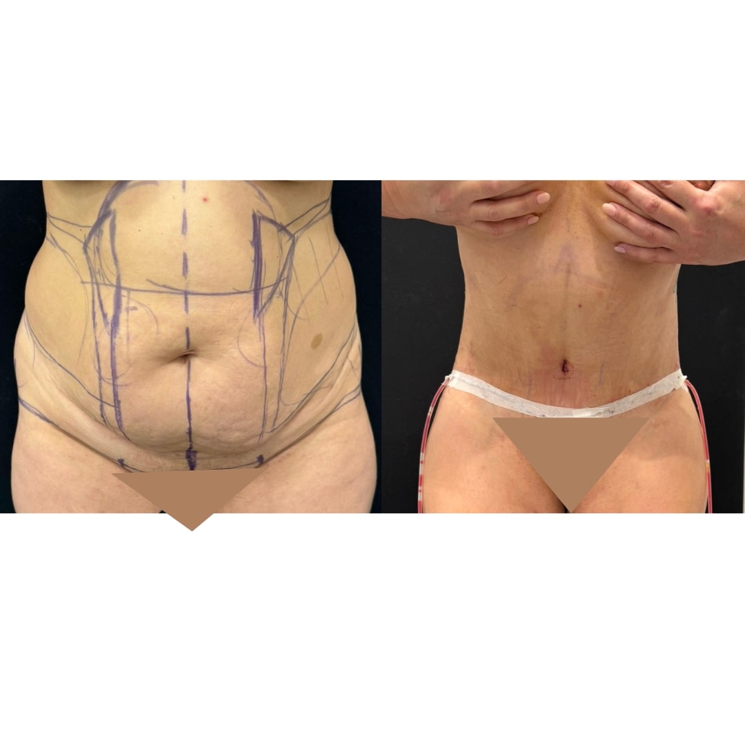 Extended Curvy Tuck Before & After Image