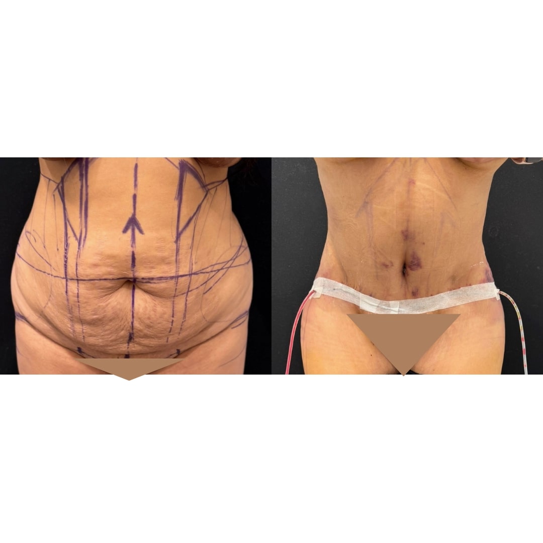Extended Curvy Tuck Before & After Image