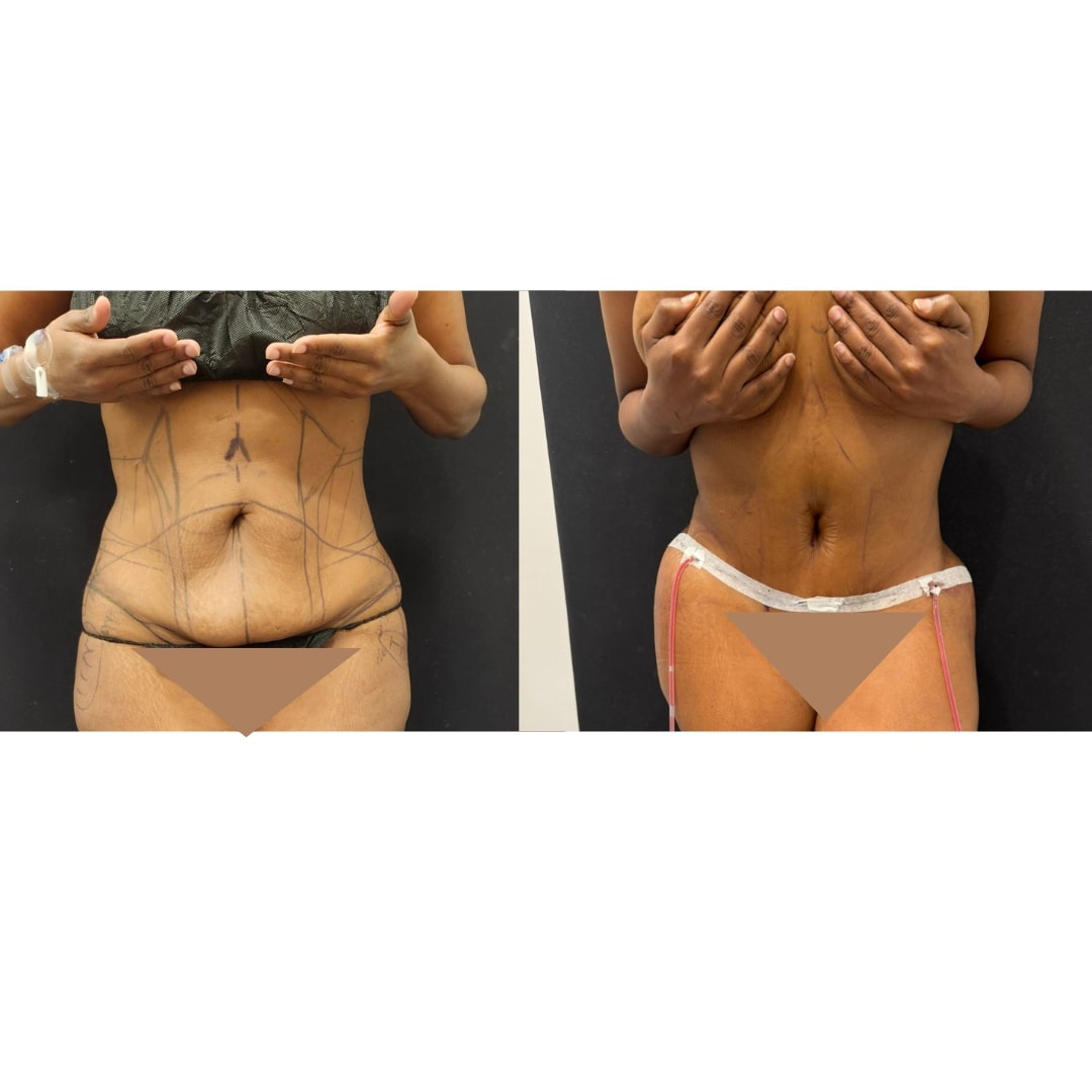 Extended Curvy Tuck Before & After Image