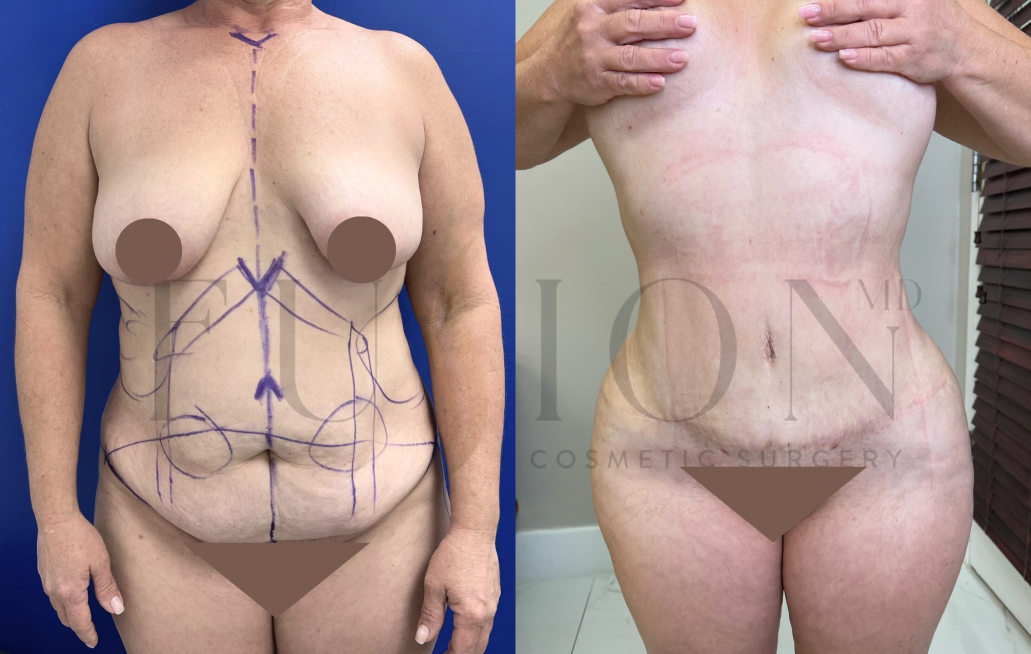 Extended Curvy Tuck Before & After Image