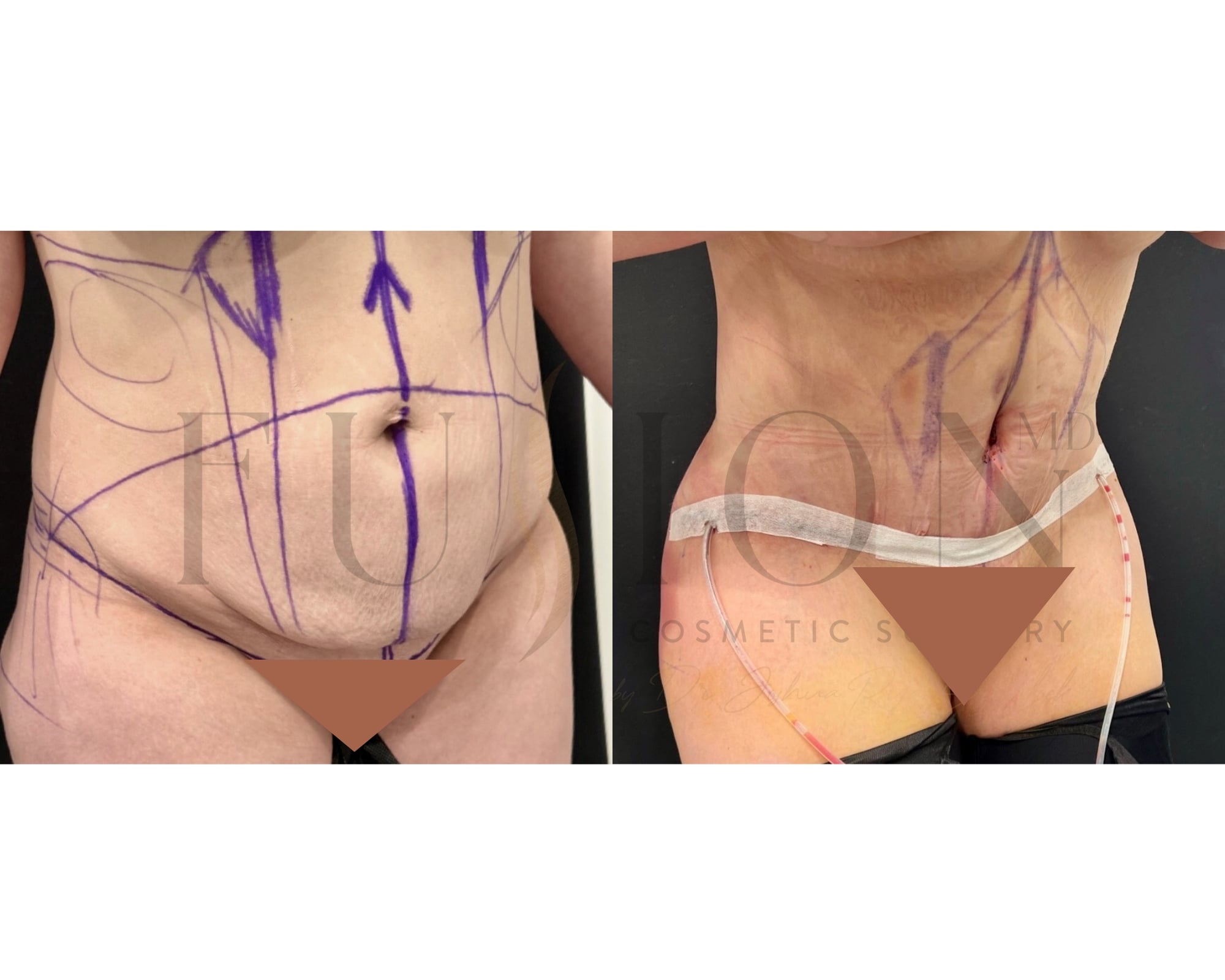 Extended Curvy Tuck Before & After Image