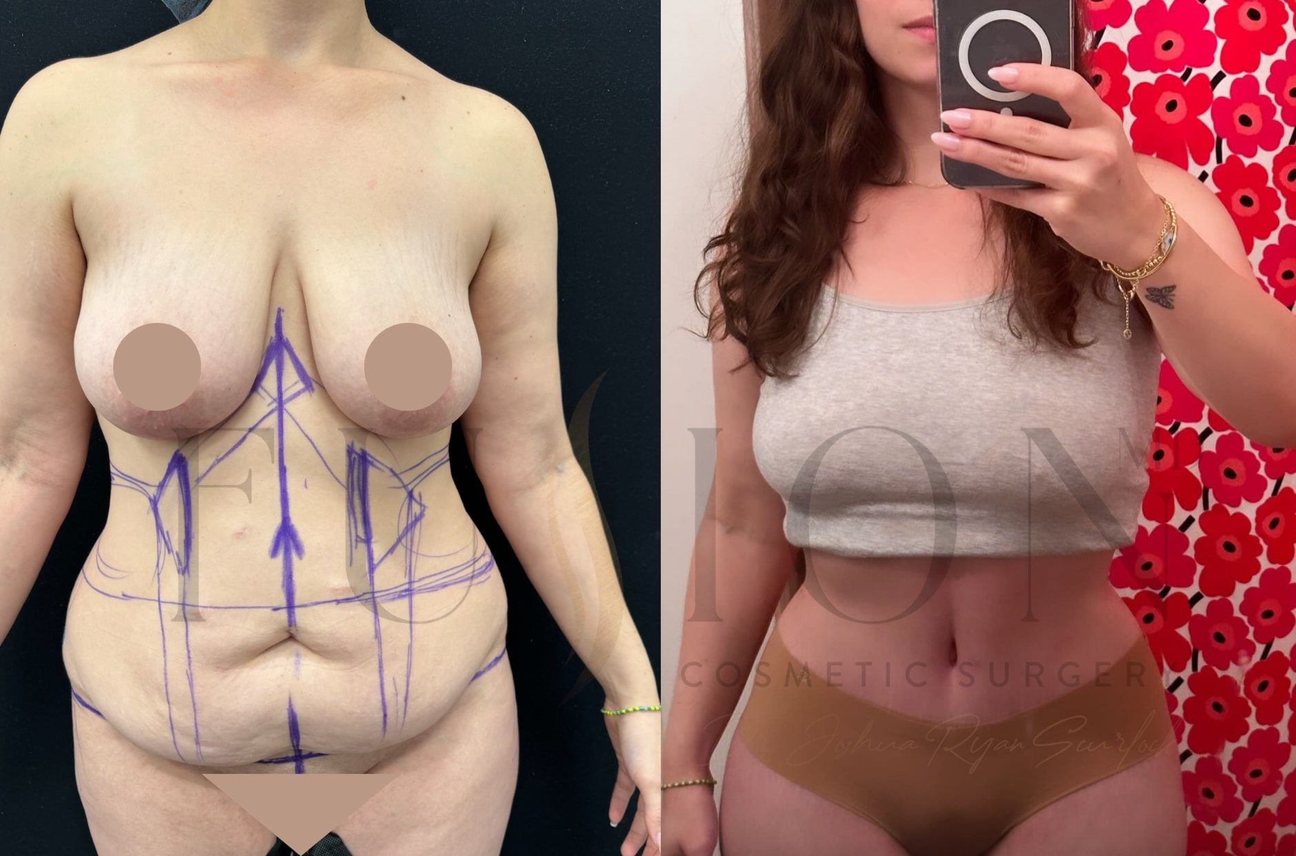 Extended Curvy Tuck Before & After Image