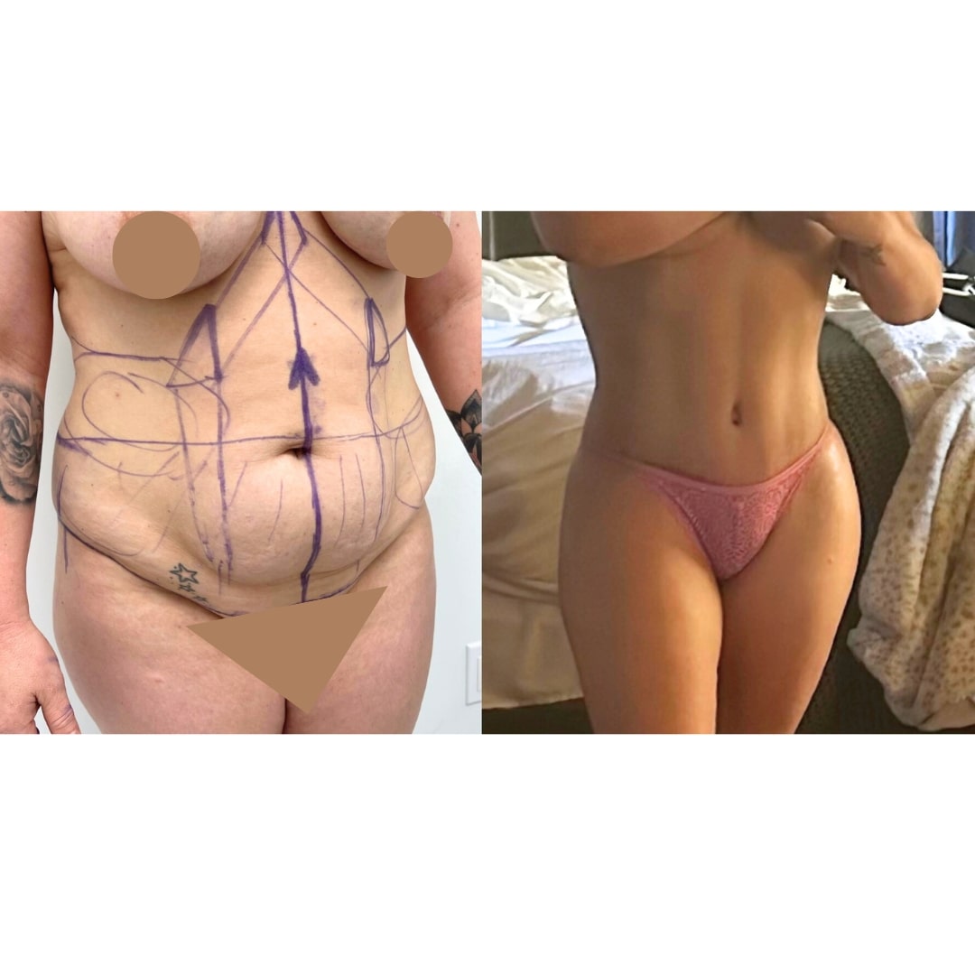 Extended Curvy Tuck Before & After Image