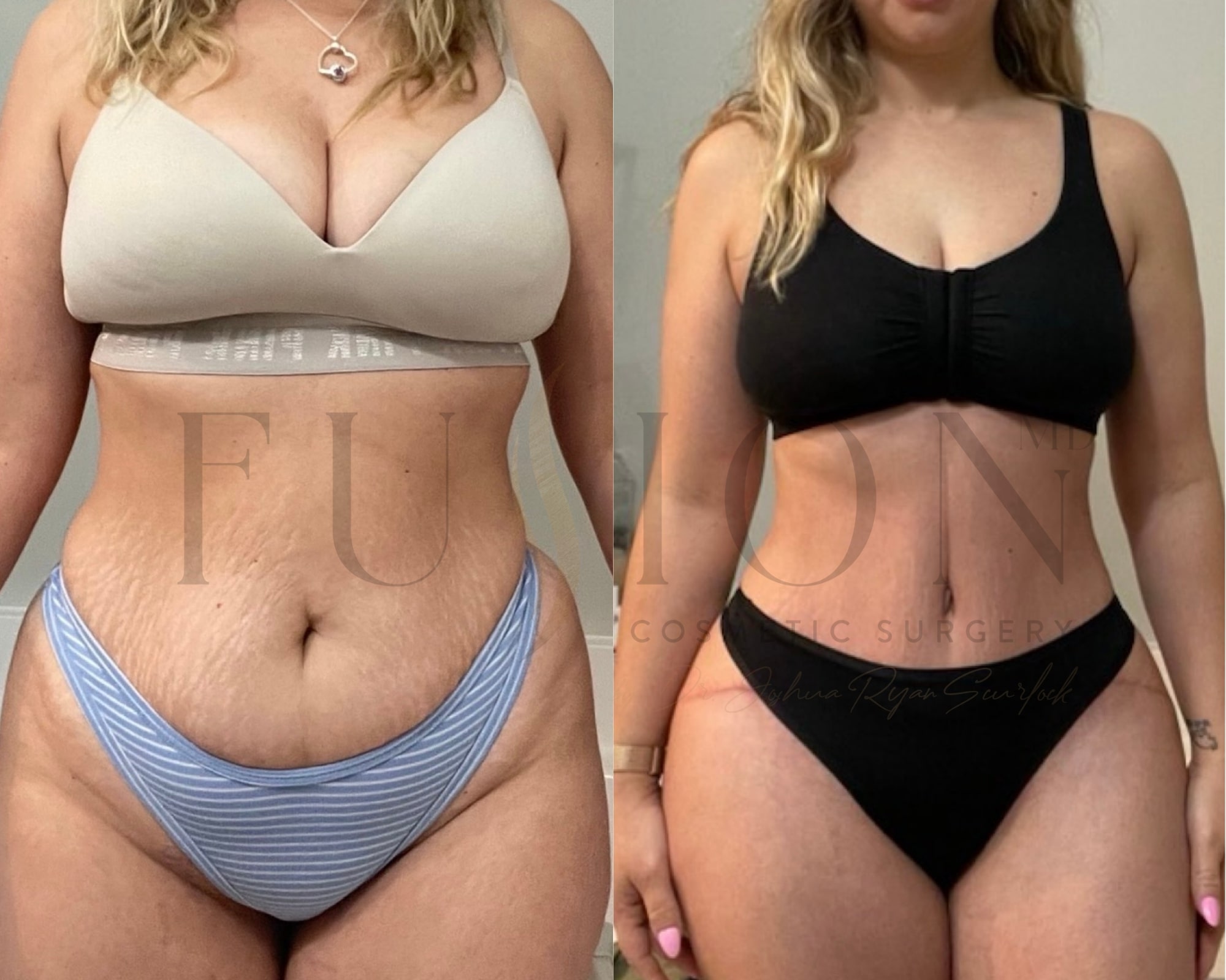 Extended Curvy Tuck Before & After Image